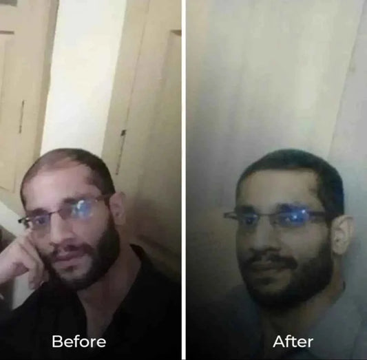 Hair growth oil with derma roller for hair and beard growth