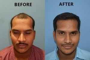 Hair growth oil with derma roller for hair and beard growth | BZOZ |