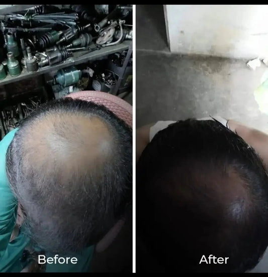 Intense hair growth oil | Made in Vietnam hair growth oil